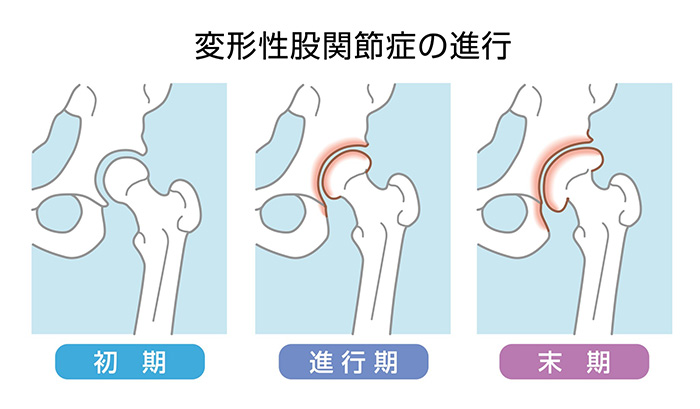 変形性股関節症